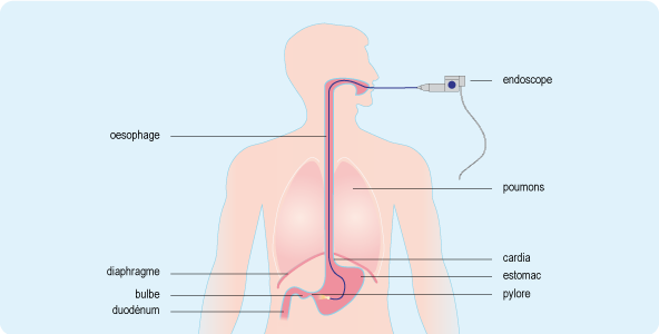 L'endoscopie digestive haute